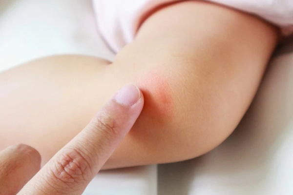 Top 5+ kem bôi muỗi đốt cho bé an toàn, hiệu quả nhất hiện nay